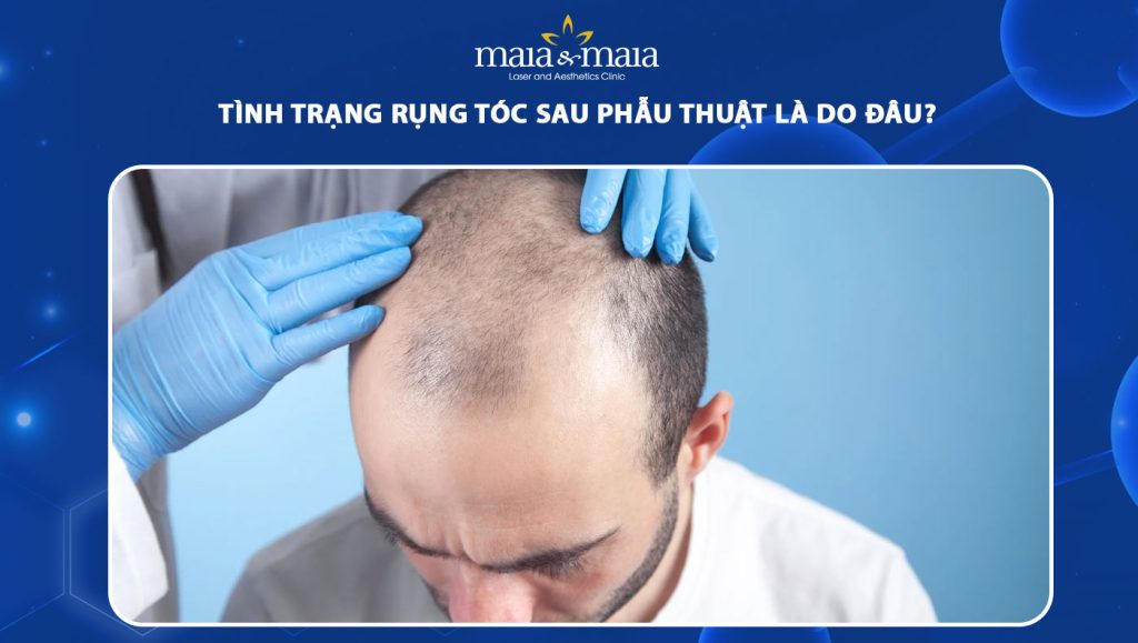 tình trạng rụng tóc sau phau thua la do dau