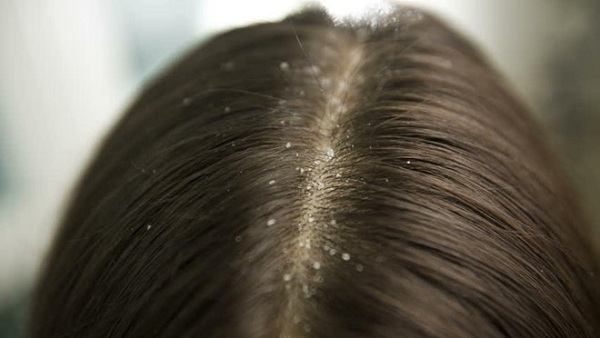 Sử dụng dầu oải hương dưỡng tóc có thể hạn chế một số triệu chứng viêm trên da đầu
