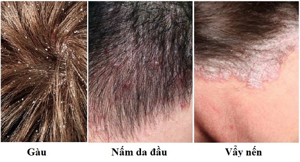 Ngứa da đầu kèm theo rụng tóc - Nguyên nhân do đâu? 3 Một số nguyên nhân gây ngứa da đầu