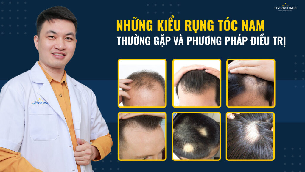 Tóc rụng nhiều ở nam Nguyên nhân và cách chữa trị hiệu quả nhất