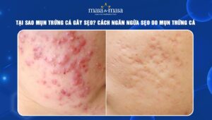 mụn trứng cá gây sẹo