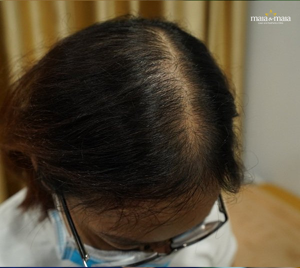 Rụng tóc nhiều ở nữ giới Nguyên nhân và cách khắc phục hiệu quả