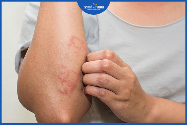 Một số bệnh da liễu có thể khiến da bị khô và ngứa