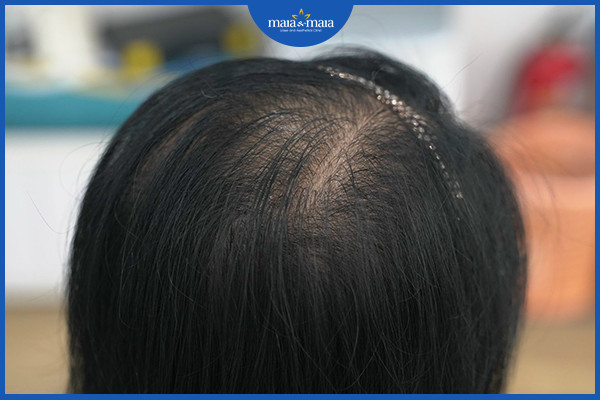 Tìm hiểu về rụng tóc Telogen và cách khắc phục  Phòng khám MaiaMaia