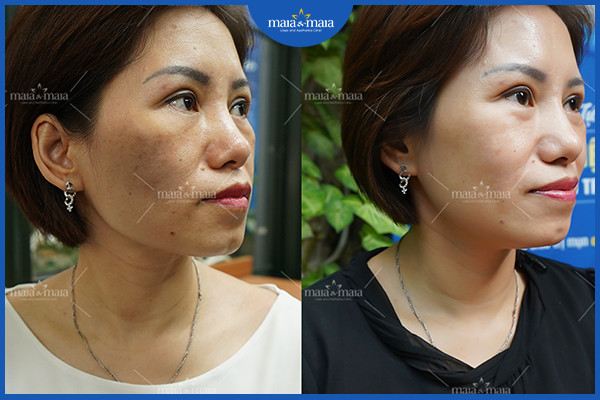 Nguyên nhân gây nám da và cách điều trị nám da hiệu quả 6 Hiệu quả điều trị nám sau điều trị tại phòng khám Maia