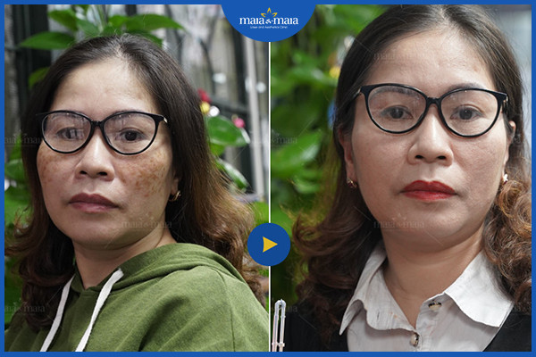 Nguyên nhân gây nám da và cách điều trị nám da hiệu quả 3 Điều trị nám da độ tuổi tiền mãn kinh