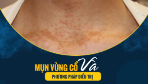 mun vung co 1