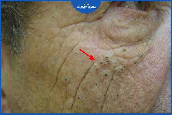 Hội chứng Favre-Racouchot ở da mặt