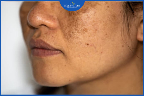 Rám má là một hiện tượng tăng sắc tố trên da