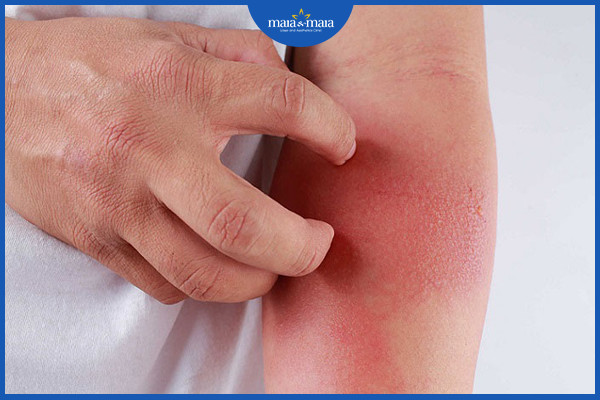 Ngứa, đỏ da có thể là một triệu chứng của viêm da tiếp xúc