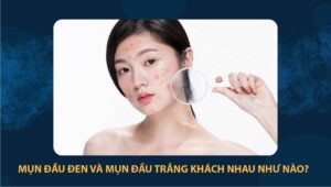 mụn đầu đen và mụn đầu trắng