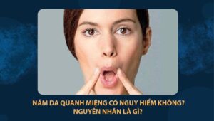 nám da quanh miệng