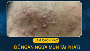 ngan ngua mun tai phat 4