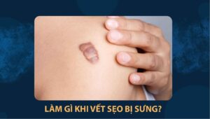 vết sẹo bị sưng