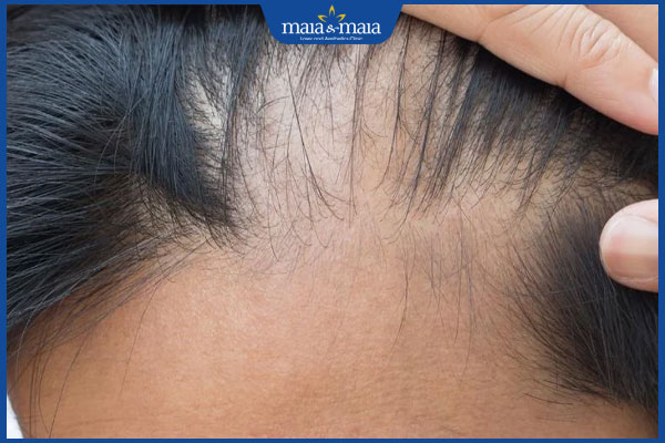 chân tóc bị yếu