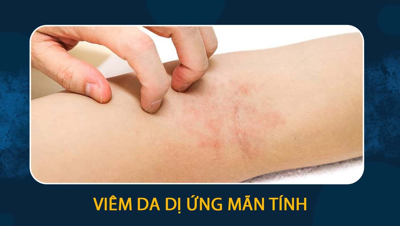 Viêm Da Dị Ứng Mãn Tính: Nguyên Nhân, Triệu Chứng và Giải Pháp Điều Trị