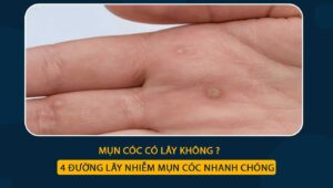 mụn cóc có lây không