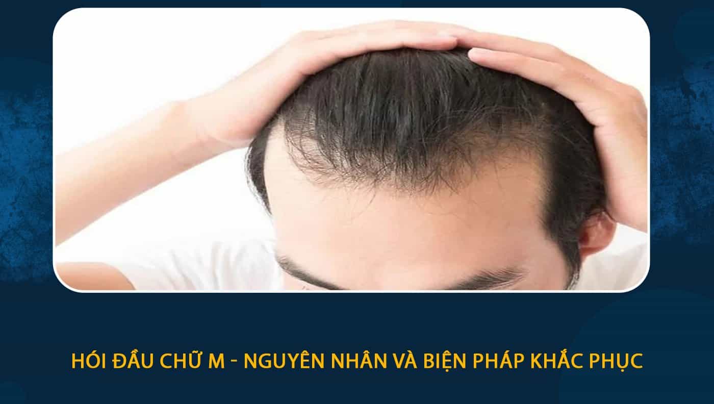 Trán chữ M nên để tóc gì Tướng số Nam Nữ trán hình chữ M  Nối Tóc Mẹ Ớt   Mẹ Ớt Hair Salon  Nối Tóc Đẹp Nhất Việt Nam