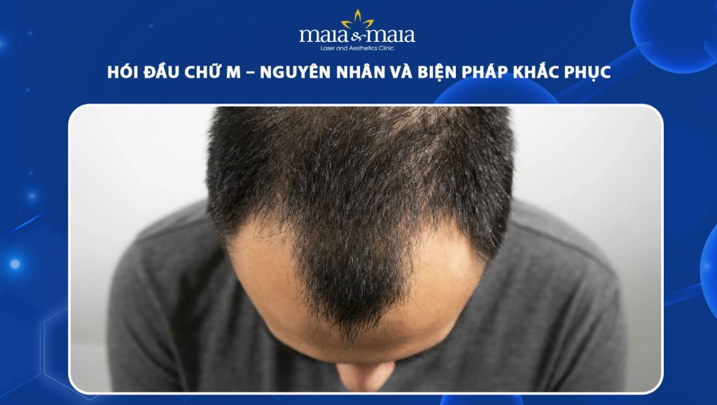 hói đầu chữ m nguyên nhân và biện pháp khắc phục
