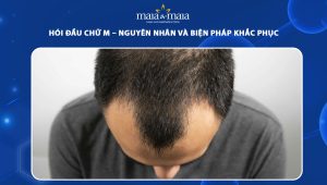 hói đầu chữ m nguyên nhân và biện pháp khắc phục