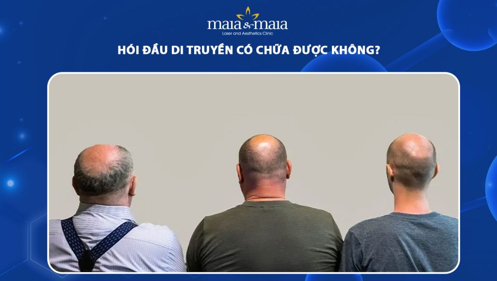 hói đầu di truyền có chữa được không