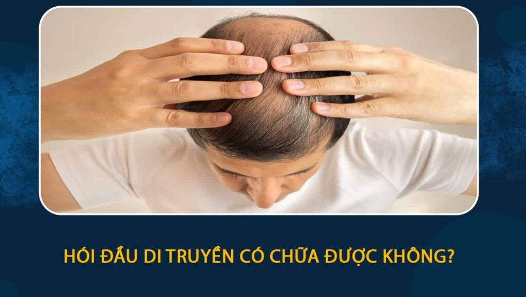 Hói đầu di truyền có chữa được không