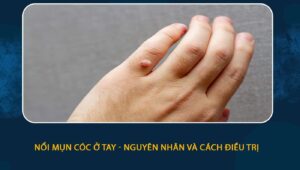 Nổi mụn cóc ở tay