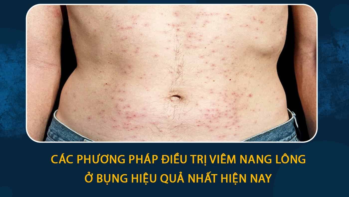 Viêm lỗ chân lông ở bụng: Nguyên nhân, Triệu chứng và Cách điều trị hiệu quả