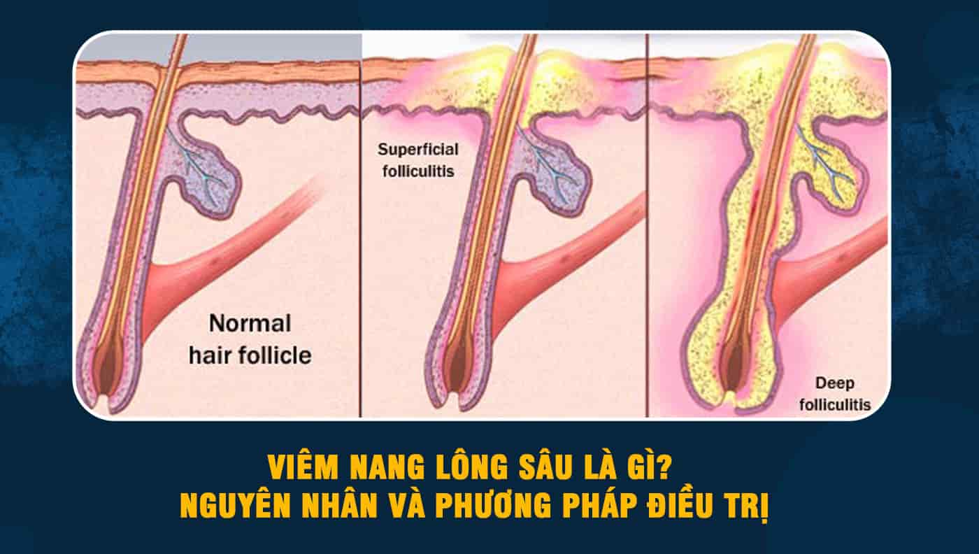 Viêm Nang Lông Sâu: Triệu Chứng, Nguyên Nhân và Cách Điều Trị Hiệu Quả