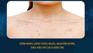 Viêm nang lông vùng ngực