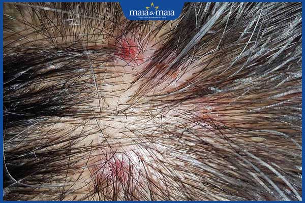 Có nên nhổ tóc ngứa không? Cách trị tóc sâu ngứa hiệu quả 2 bệnh viêm nang tóc