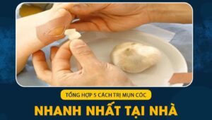 cách trị mụn cóc nhanh nhất tại nhà