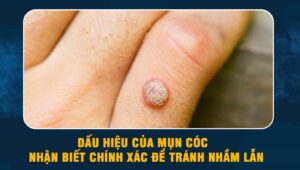 dấu hiệu của mụn cóc