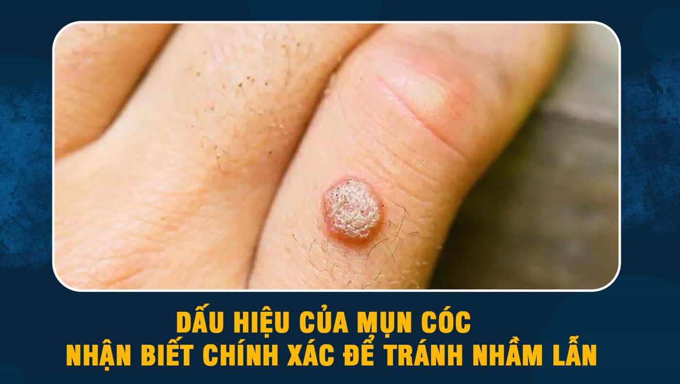 3. Các loại mụn cóc thường gặp