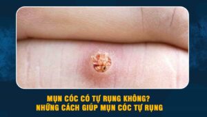 Mụn cóc có tự rụng không