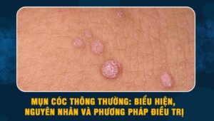 Mụn cóc thông thường