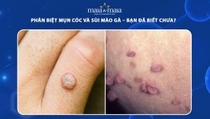 mụn cóc và sùi mào gà