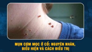 Mụn cơm mọc ở cổ