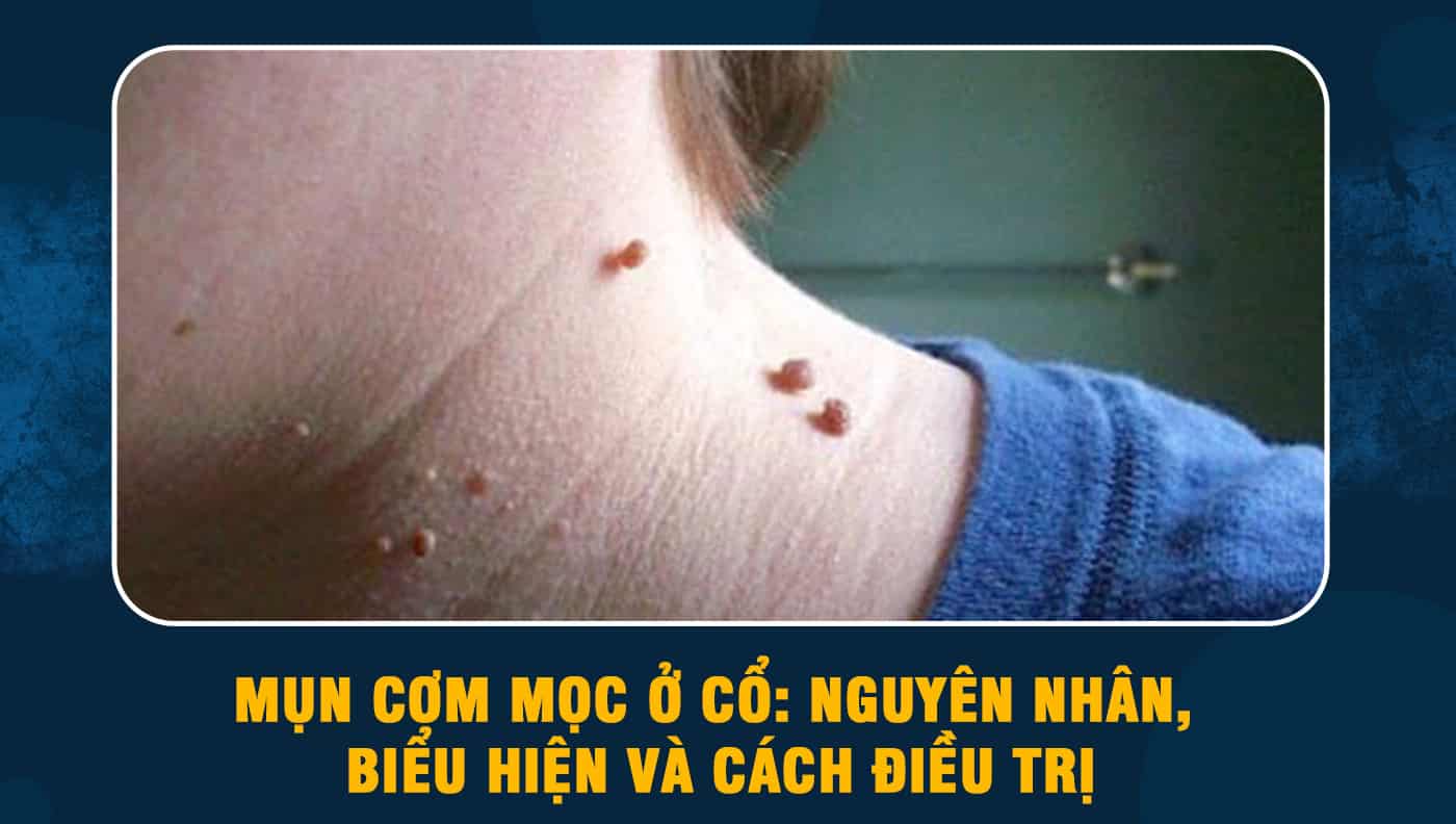 6. Câu Hỏi Thường Gặp Về Mụn Cóc Ở Cổ