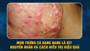 mụn trứng cá dạng nang