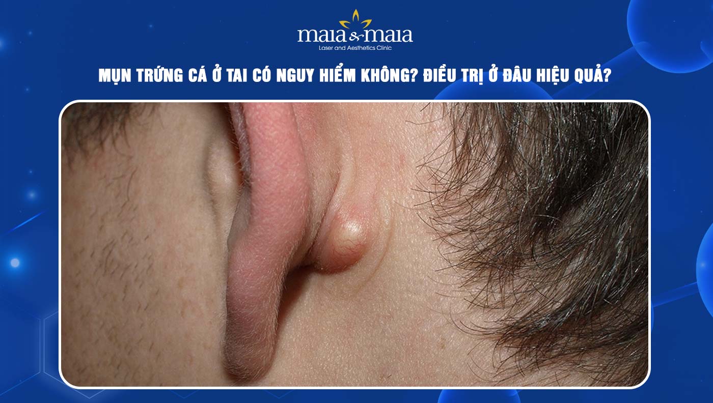 Mụn trứng cá ở tai: Nguyên nhân, điều trị và cách phòng ngừa hiệu quả