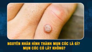 Nguyên nhân hình thành mụn cóc