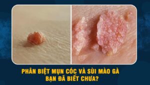 phân biệt mụn cóc và sùi mào gà