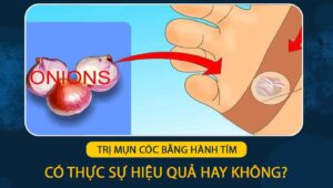 Trị mụn cóc bằng hành tím