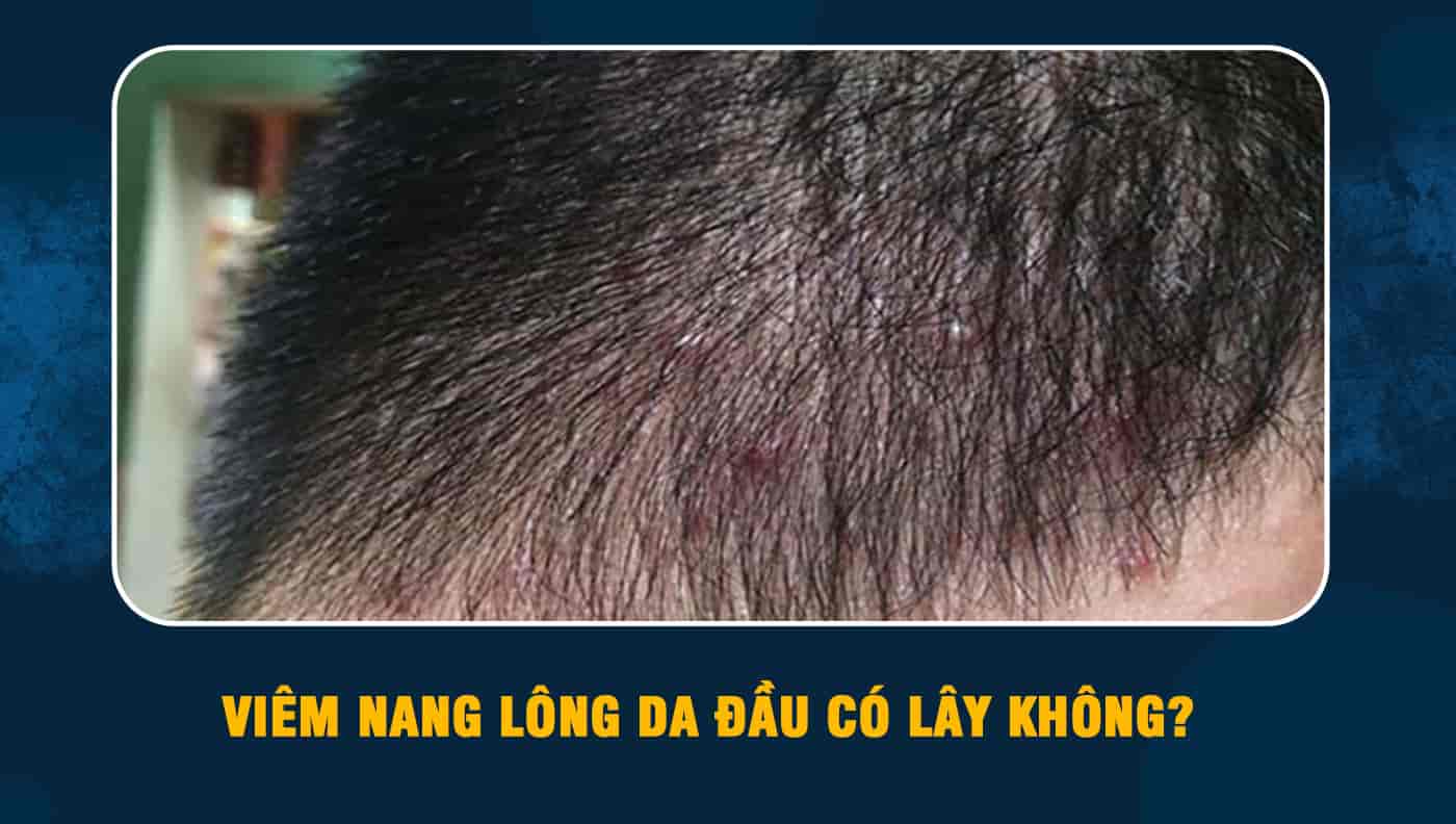 viêm nang lông ở da đầu  BvNTP