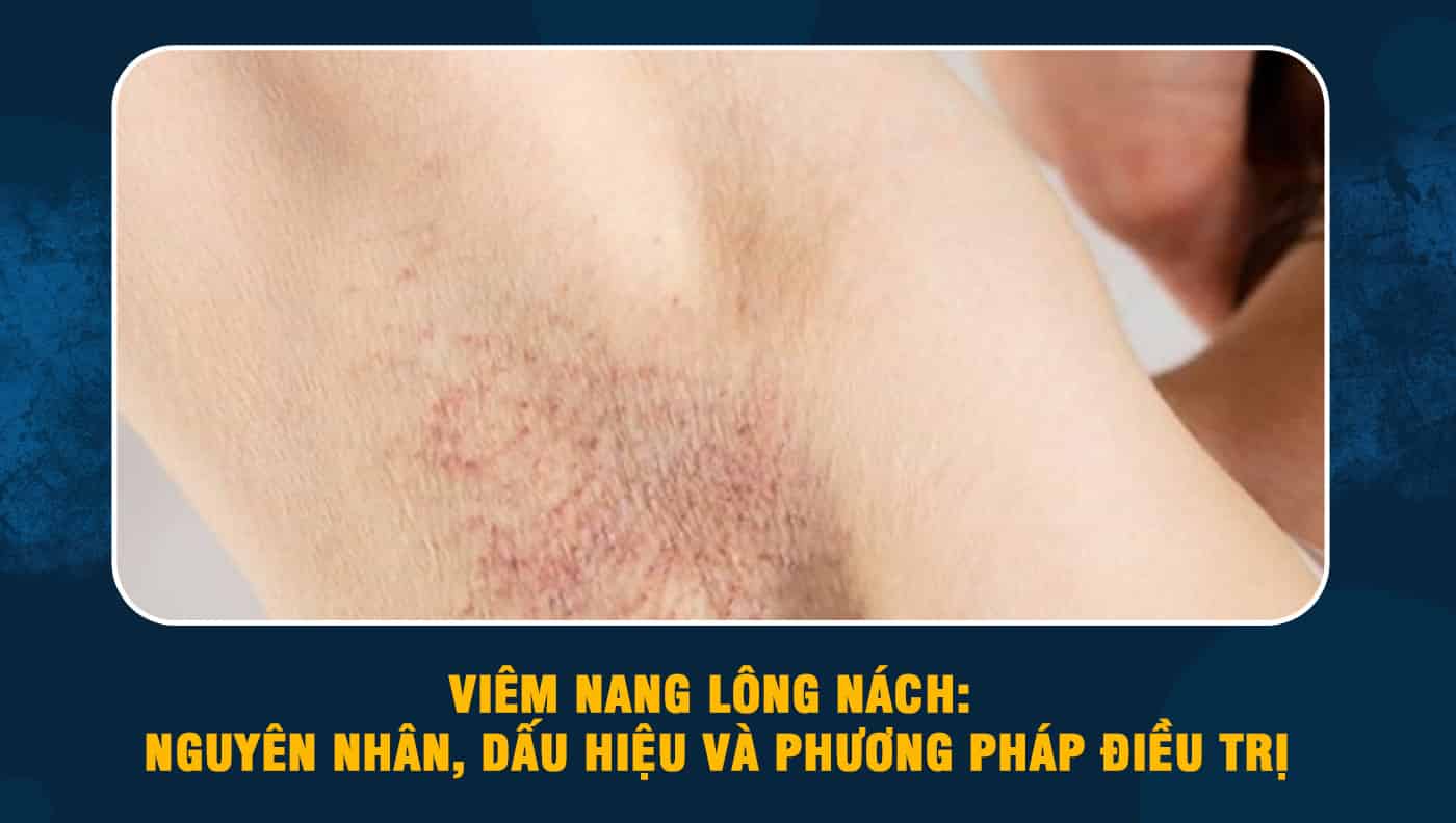 4. Biến chứng của viêm nang lông vùng nách