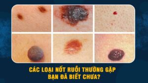 Các loại nốt ruồi