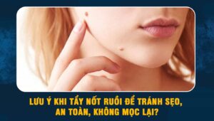 lưu ý khi tẩy nốt ruồi