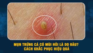 mụn trứng cá có mùi hôi