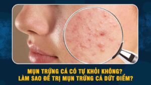 Mụn trứng cá có tự khỏi không